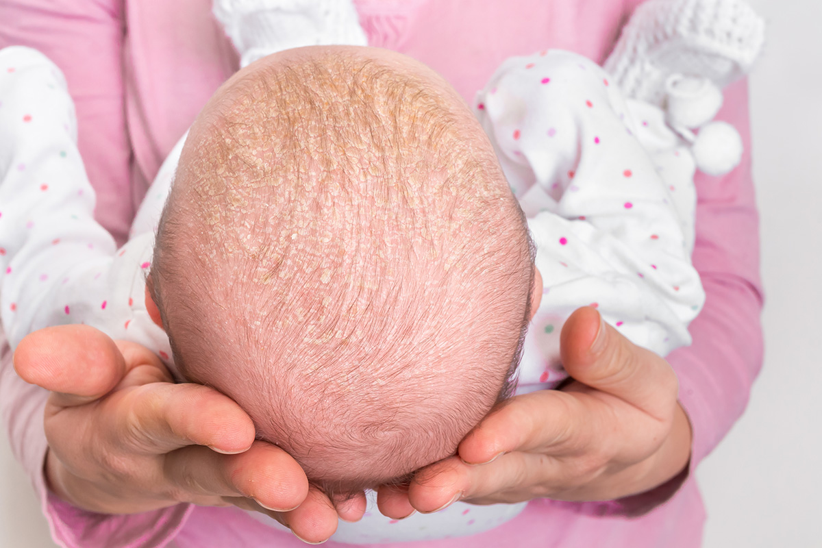Trockene Kopfhaut bei Babys